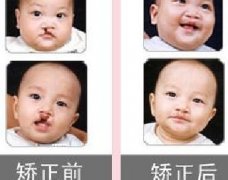 吃兔肉真的會(huì)長兔唇？為什么會(huì)長兔唇？